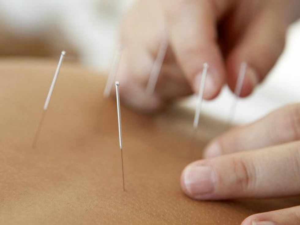 Acupuncture