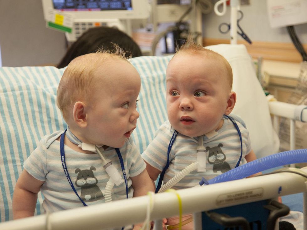 Formerly Conjoined Twins Clear Health Hurdles To Leave Dallas Hospital Culturemap Dallas