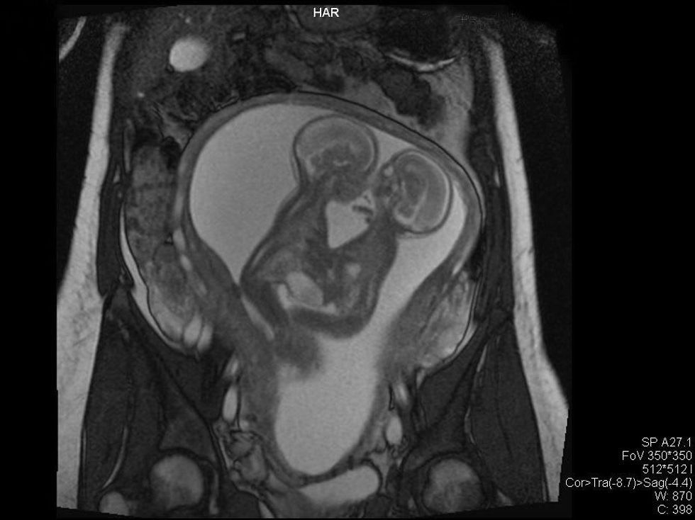 Owen and Emmett Ezell sonogram